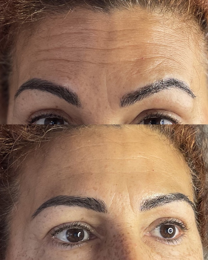 Toxina botulínica antes y después — frente y entrecejo sin arrugas, Mendoza