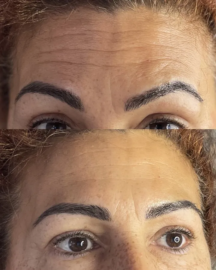 Toxina botulínica antes y después — frente y entrecejo sin arrugas, Mendoza