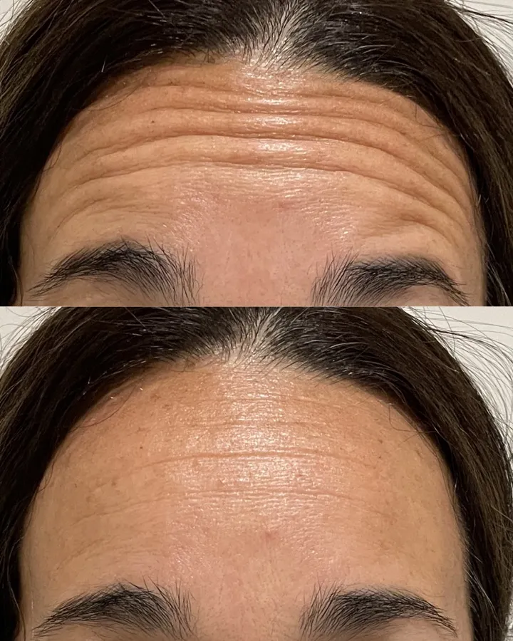 Resultado botox frente — arrugas horizontales eliminadas con toxina botulínica