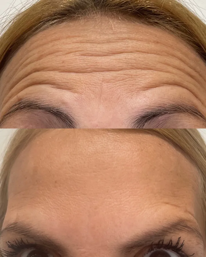 Antes y después botox — frente lisa y natural, Dra. Carolina Soler Mendoza