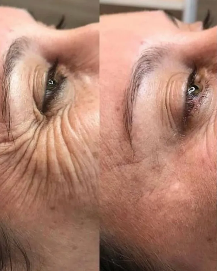 Botox patas de gallo antes y después — zona ocular sin arrugas Mendoza