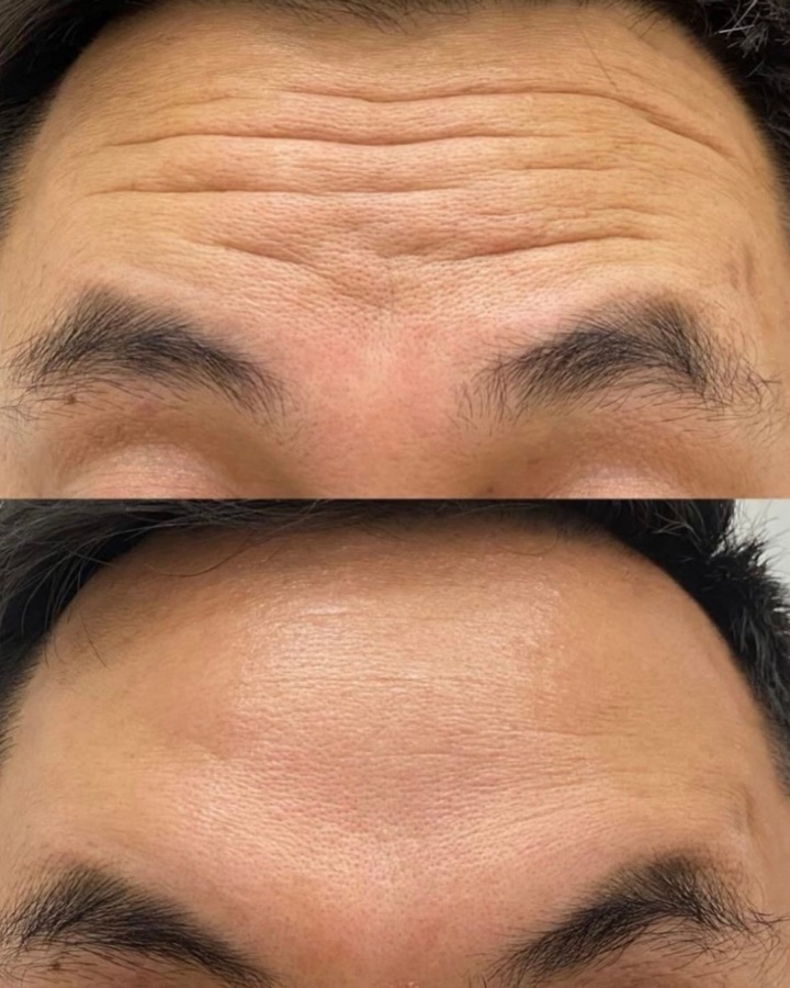 Toxina botulínica masculina antes y después — resultado natural Mendoza