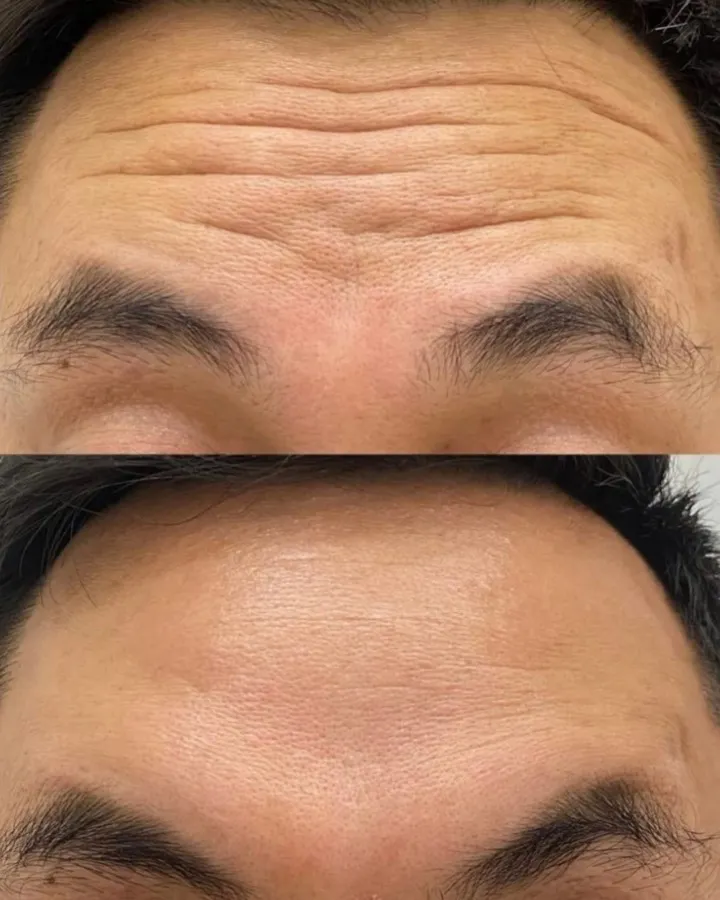 Toxina botulínica masculina antes y después — resultado natural Mendoza