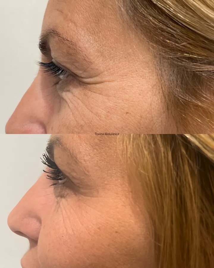 Resultado botox patas de gallo — expresión natural y relajada Mendoza