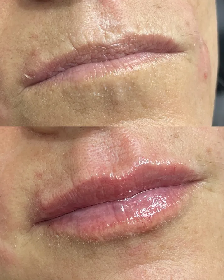 Relleno labial antes y después — labios voluminosos y naturales, Mendoza