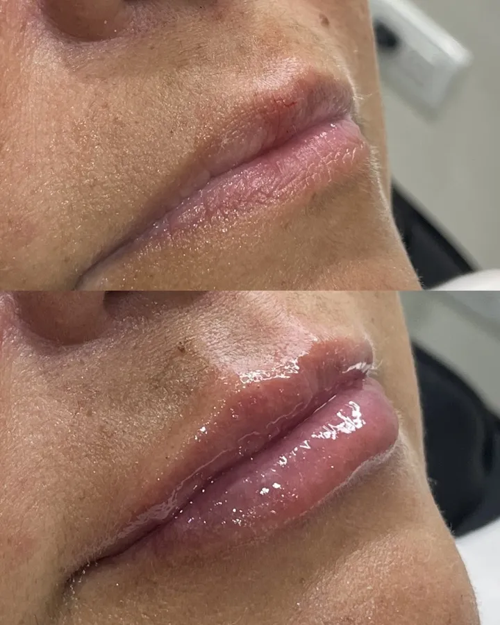 Resultado relleno labial con ácido hialurónico — Dra. Carolina Soler, Mendoza