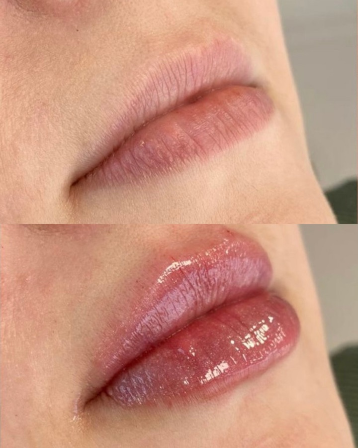 Antes y después labios — relleno natural y armonioso Mendoza