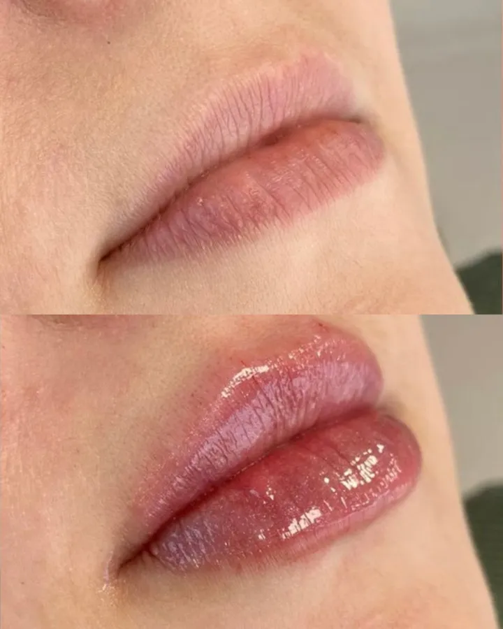 Antes y después labios — relleno natural y armonioso Mendoza