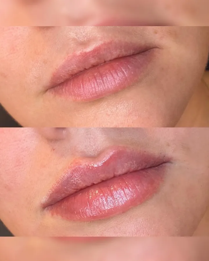 Relleno labial antes y después — volumen y definición de labios Mendoza
