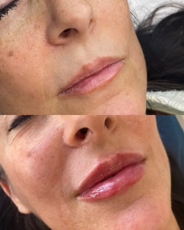 Labios antes y después — resultado natural con hialurónico Mendoza