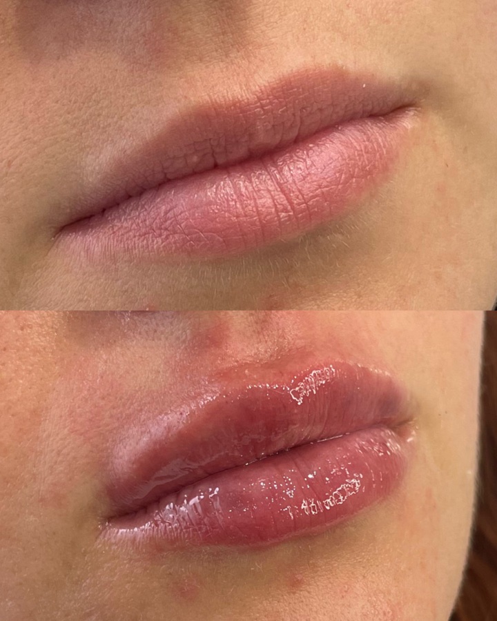 Relleno labial resultado — labios definidos y naturales Mendoza