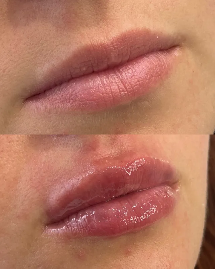 Relleno labial resultado — labios definidos y naturales Mendoza