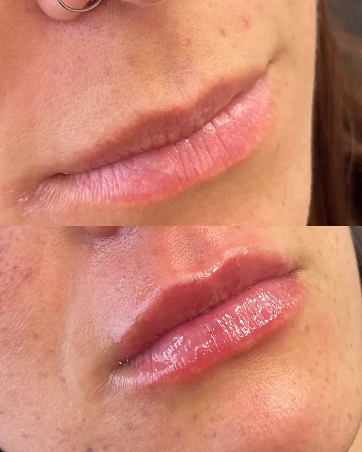 Antes y después relleno labial — Dra. Carolina Soler Mendoza