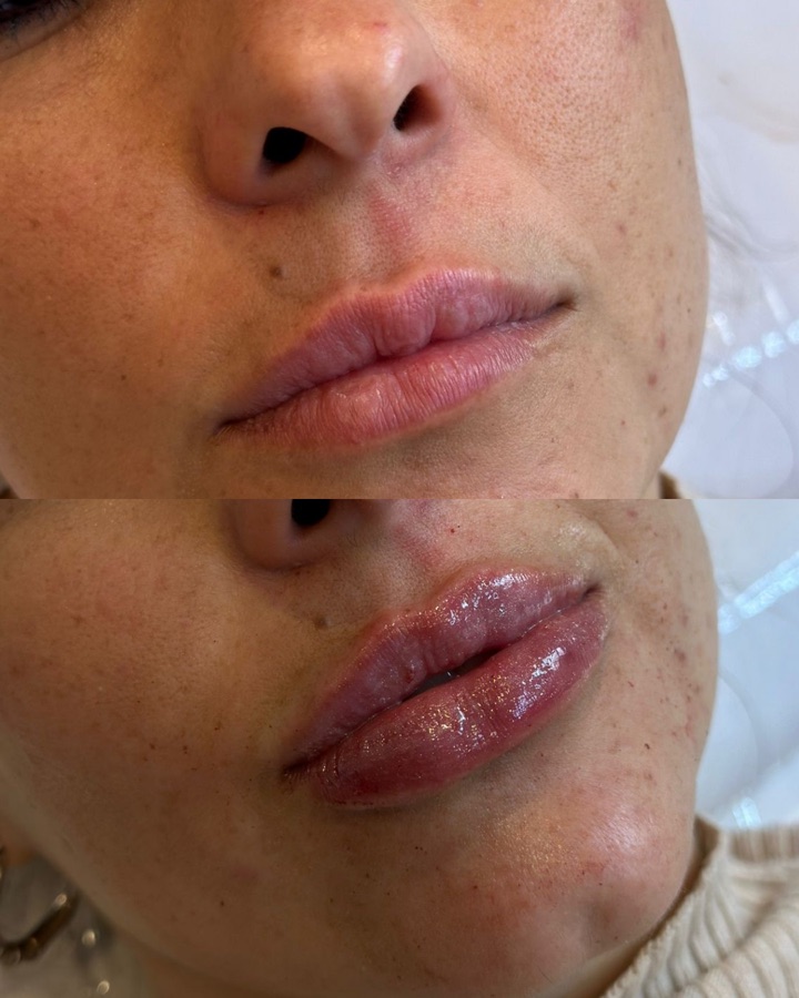 Resultado labios con ácido hialurónico — volumen natural sin exagerar