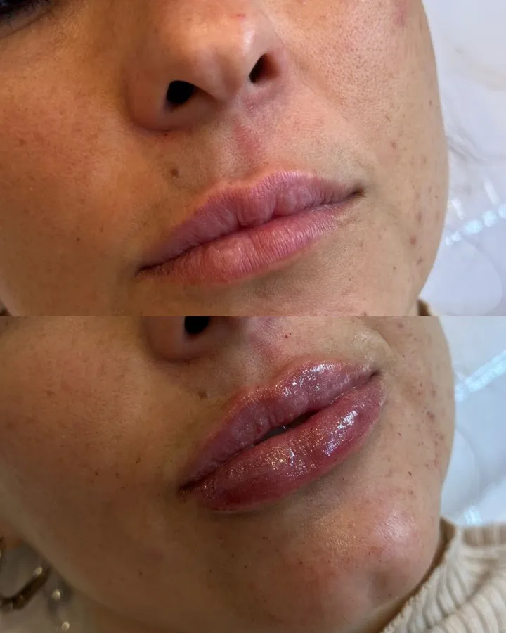 Resultado labios con ácido hialurónico — volumen natural sin exagerar