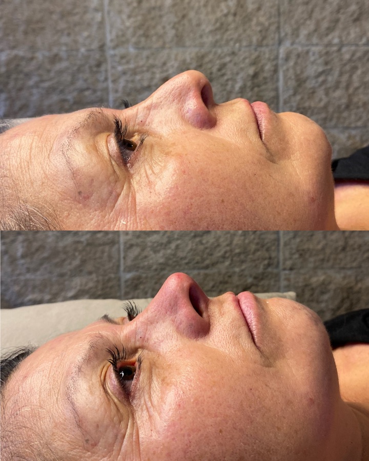 Rinomodelación antes y después — perfil nasal armonizado con ácido hialurónico, Mendoza