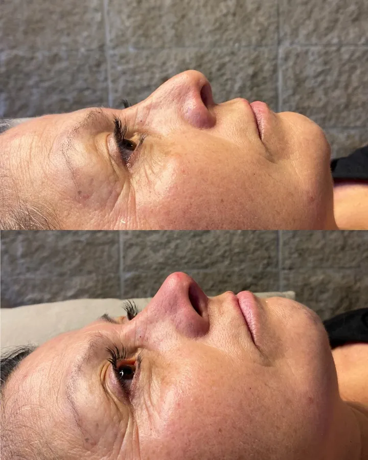 Rinomodelación antes y después — perfil nasal armonizado con ácido hialurónico, Mendoza