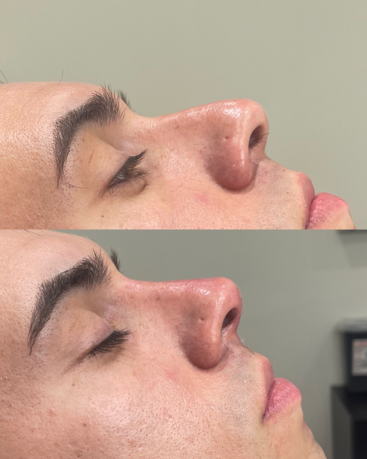 Antes y después rinomodelación — punta nasal armonizada con hialurónico
