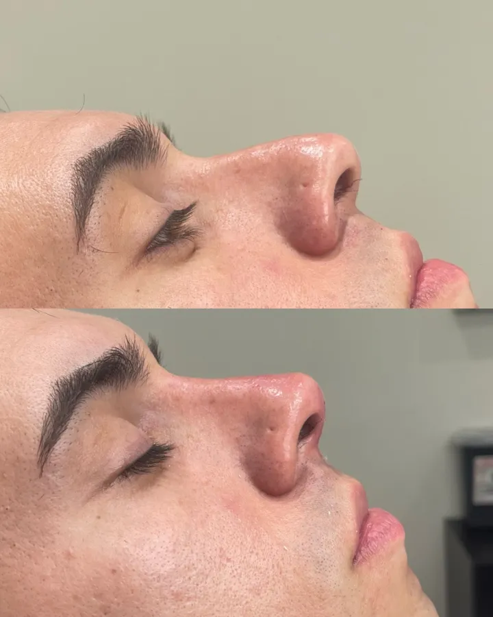 Antes y después rinomodelación — punta nasal armonizada con hialurónico