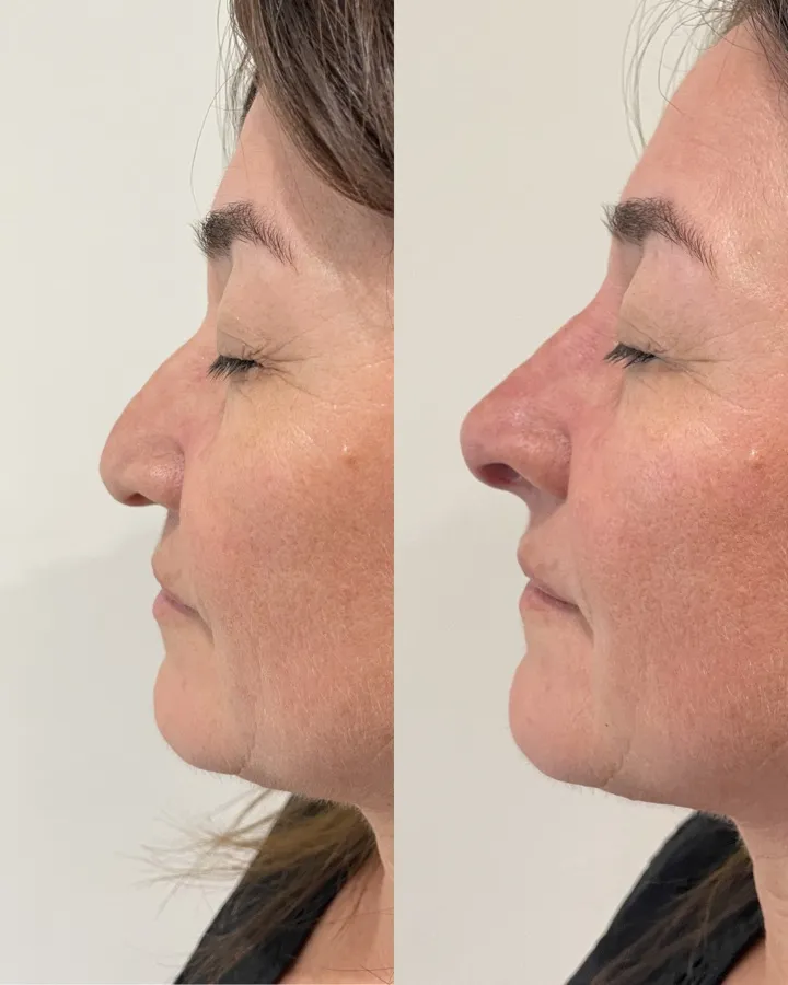Perfil nasal antes y después — rinomodelación sin cirugía Mendoza