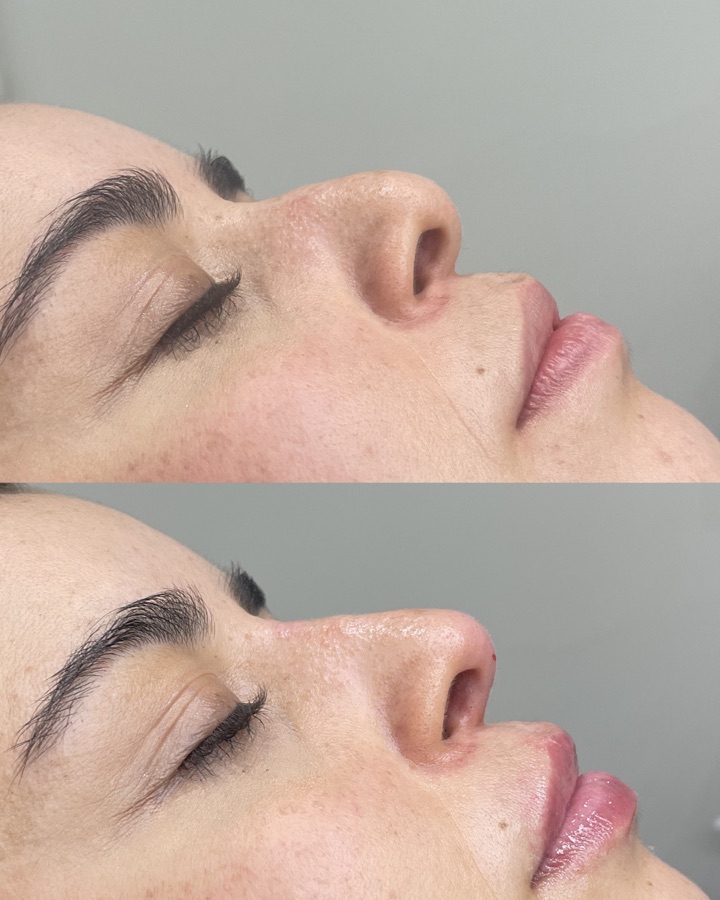 Antes y después rinomodelación — resultado inmediato y natural