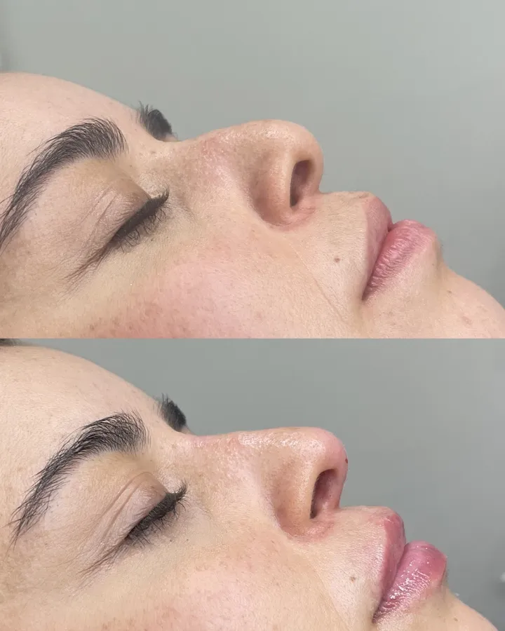 Antes y después rinomodelación — resultado inmediato y natural