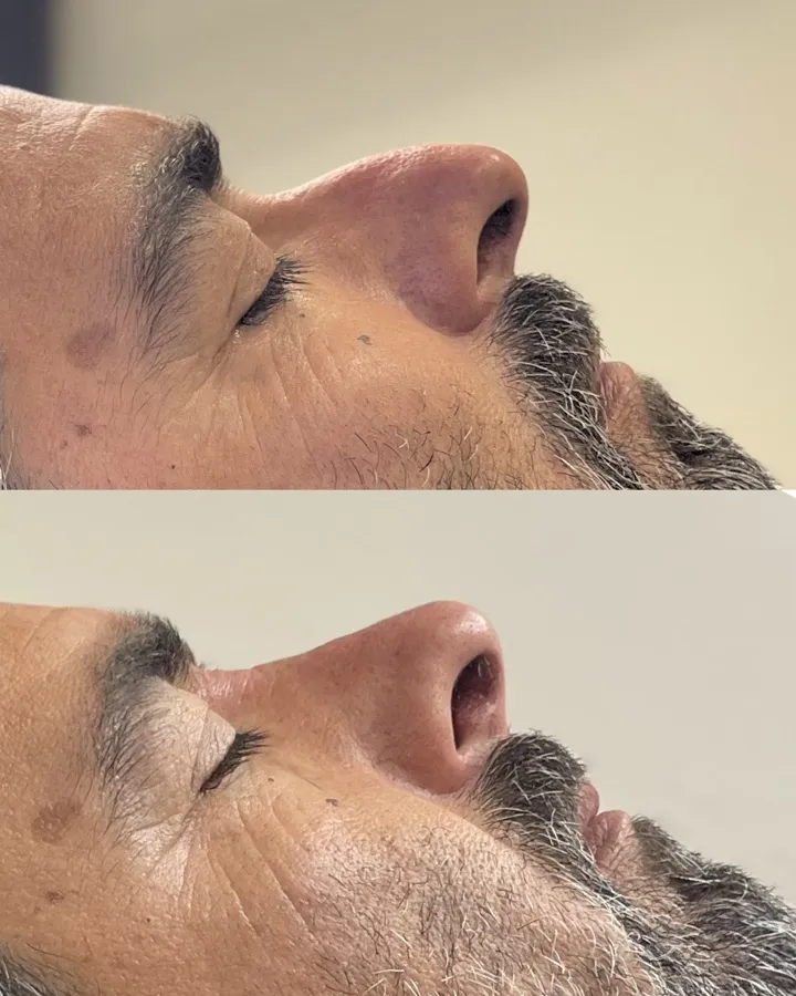 Rinomodelación masculina antes y después — Dra. Carolina Soler